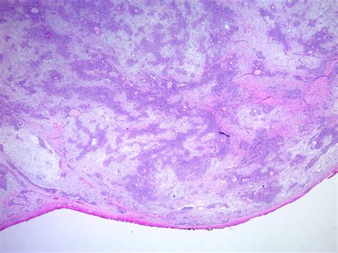 Pathology Outlines Chondroid Syringoma