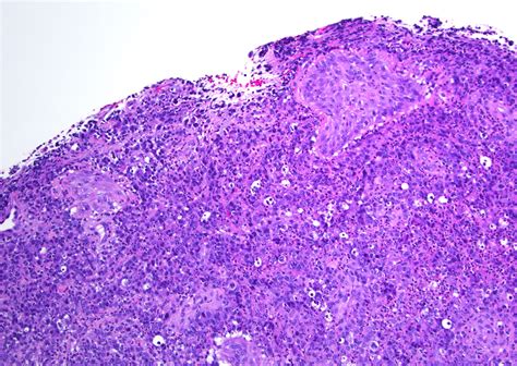 Pathology Outlines Primary Cutaneous Anaplastic Large Cell Lymphoma