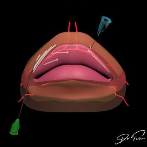 3d Lip Anatomy Vertical Horizontal Injections Dr Tim Pearce