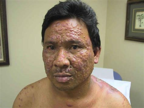 Download the perfect skin disease pictures. Leprosy disease causes, symptoms, diagnosis, treatment and ...