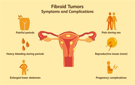 Uterine Fibroids Causes Signs Symptoms Diagnosis And Management Sexiz Pix
