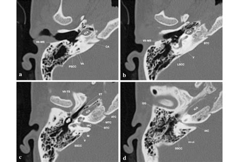 Normal Anatomy Of Inner Ear Structures In High Resolution Ct Selection