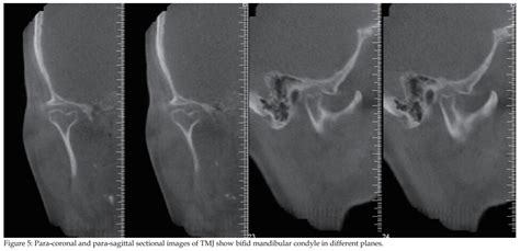 An Overall Look For Temporomandibular Joint Pathologies And Imaging