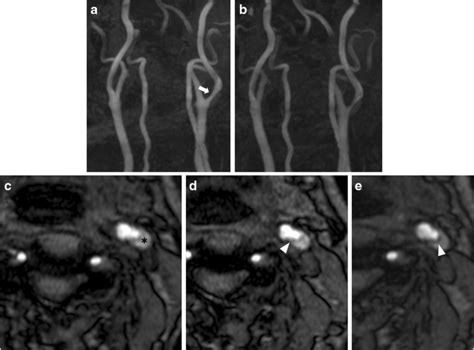 Time Of Flight Magnetic Resonance Angiogram TOF MRA Of Case 1 Before