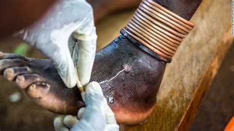 Hunting The Fiery Serpent The Quest To Wipe Out Guinea Worm Cnn