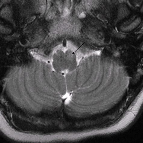 Transverse T2 Weighted Mri Scan Of The Cervical Spinal Cord At The C2