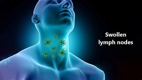 Swollen Lymph Nodes Symptoms Causes And Treatment