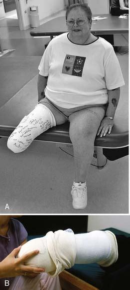 Rehabilitation And Prosthetic Restoration In Lower Limb Amputation