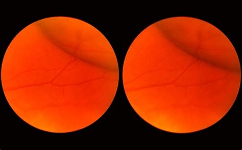 Scleral Indentation In A Normal Eye Retina Image Bank