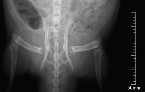 Anteroposterior Pelvic Radiographs And Acetabular Tissue Of Ddh Model