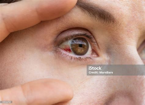 Subconjunctival Hemorrhage Burst Blood Vessel In Eye Bloodshot Eye