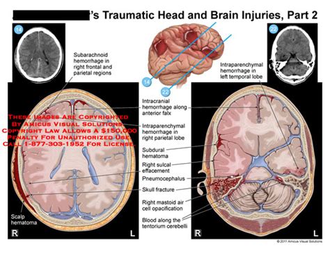 AMICUS Illustration Of Amicus Injury Head Injuries Traumatic Brain Part