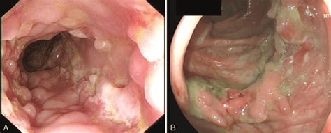 Ulcerative Colitis Intestinal Tuberculosis Inflammatory Bowel My XXX