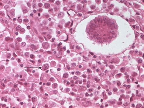 Tumoral Cells With Eosinophilic Cytoplasm Round Or Convoluted Nuclei