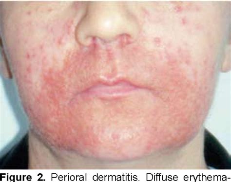 Figure 2 From Perioral Dermatitis Semantic Scholar