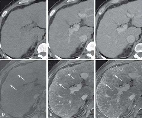Imaging Of The Cirrhotic Liver Radiology Key