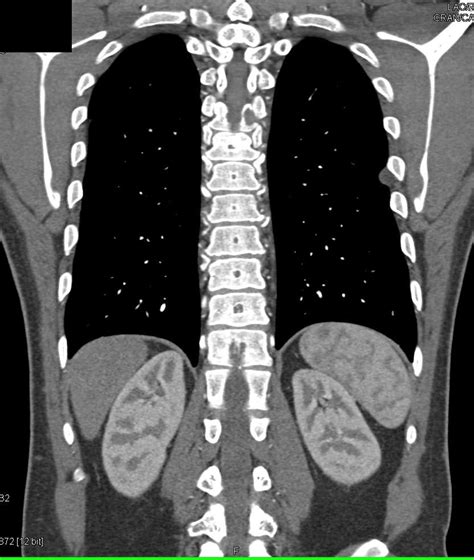 Lung Mass And Rib Metastases Chest Case Studies Ctisus Ct Scanning