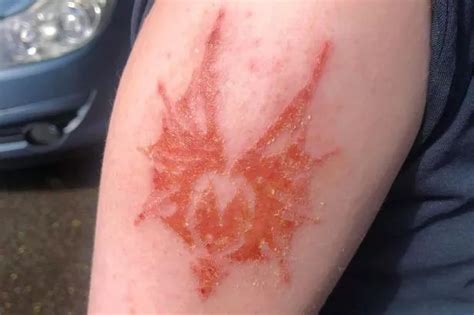 Mums Henna Warning After Schoolboy 10 Suffers Chemical Burn And Is