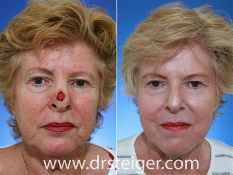 Mohs Surgery Reconstruction Before And After Photos