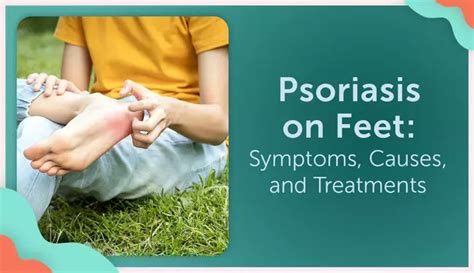 Psoriasis On Feet Symptoms Causes And Treatments Mypsoriasisteam