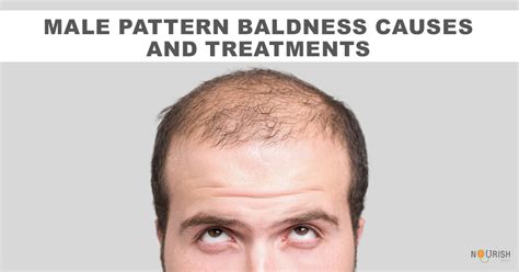 Male Pattern Baldness Causes Treatments Nourishdoc