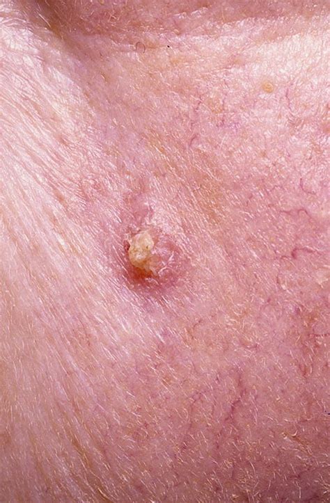 Early Signs Of Skin Cancer Pictures 15 Photos And Images