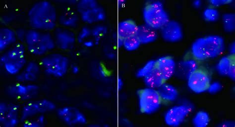 Fish For Her 2 Gene Amplification Figure 2 A Negative Amplification