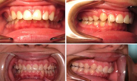 Can You Fix An Overbite With Invisalign Dr Mario Paz Dds Orthodontist