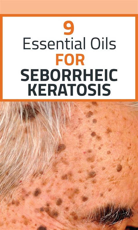 Seborrheic Keratosis Symptoms Causes Treatment And Prevention Of