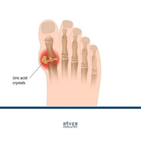 Gout — River Podiatry I The Best Foot And Ankle Care In Nynj