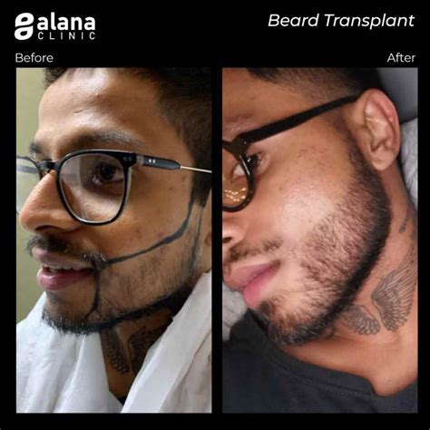 Beard Transplant Alana Hair Clinic
