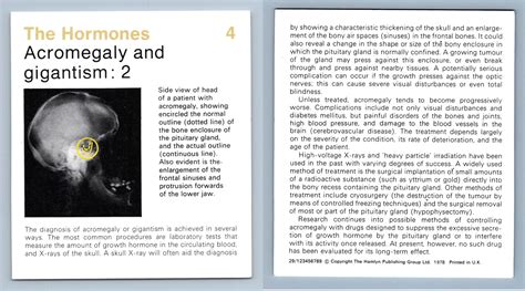 Acromegaly And Gigantism 2 4 Hormones Home Medical Guide 1975 8 Hamlyn