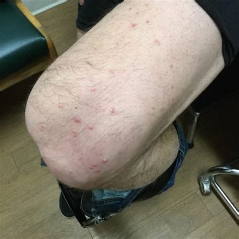 Dermdx Rash On Arms Knees And Back Clinical Advisor