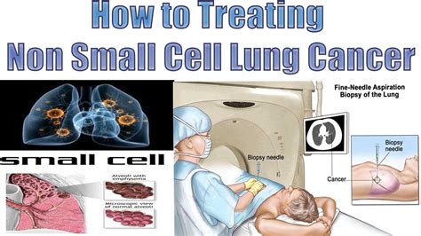 How To Treating Non Small Cell Lung Cancer Non Small Cell Lung Cancer