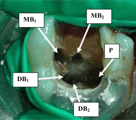 FULL TEXT The Root Canal Treatment In Maxillary And Mandibular Molars