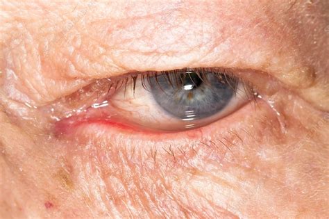 Ectropion Drooping Of The Eyelid Stock Image C0156009 Science