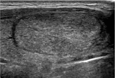 In most cases, the lump affects only one side, and the results of thyroid function ultrasound guided fine needle aspiration biopsy fine needle aspiration biopsy (fna). Thyroid Ultrasound