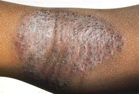 Medical Pictures Info Asteatotic Eczema