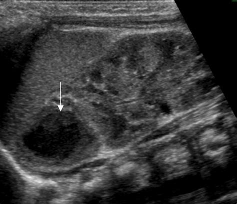 Imaging Of Nonmalignant Adrenal Lesions In Children Radiographics