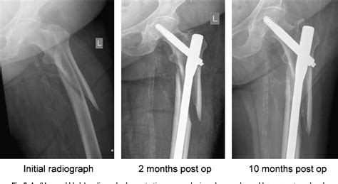 Figure 2 From Subtrochanteric Hip Fractures Treated With Cerclage