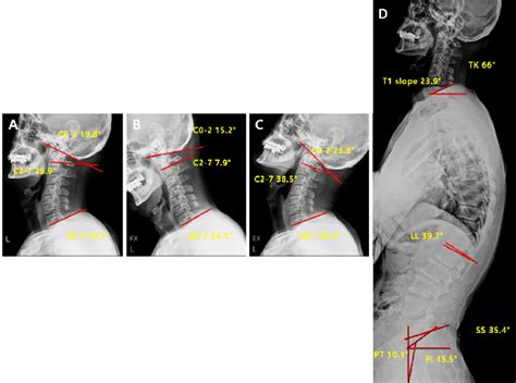 Post Operative Radiological Parameter In Lordosis Groups Cervical