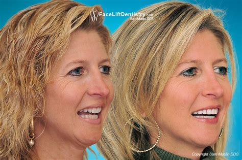 It is common for overbite patients to have faces that are short and round in appearance. Healthy Gums Start Here With This Outstanding Suggestions