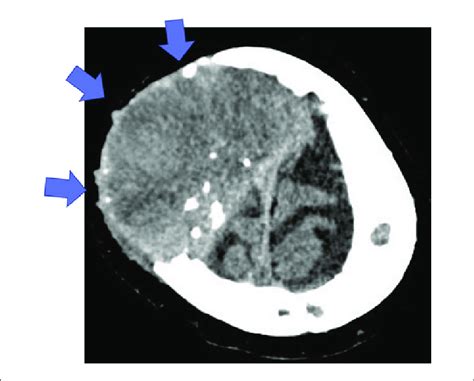 Ct Scan Showing A Cranial Bone Tumor Which Has Infiltrated The