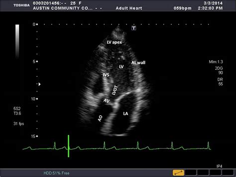 Apical Window Sonography Resources