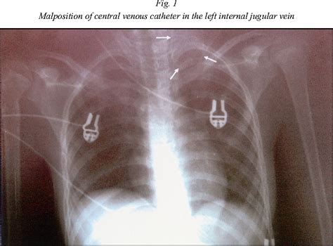 Figure From Malposition Of Central Venous Catheter In The Left