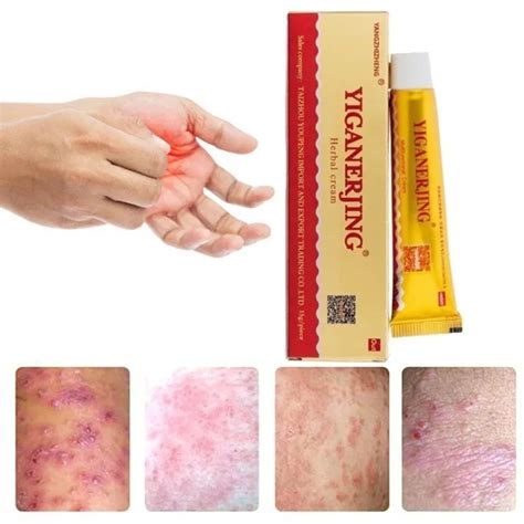 Psoriasis Dermatitis Cream Natural Herbal Cream Relief Itching Eczema