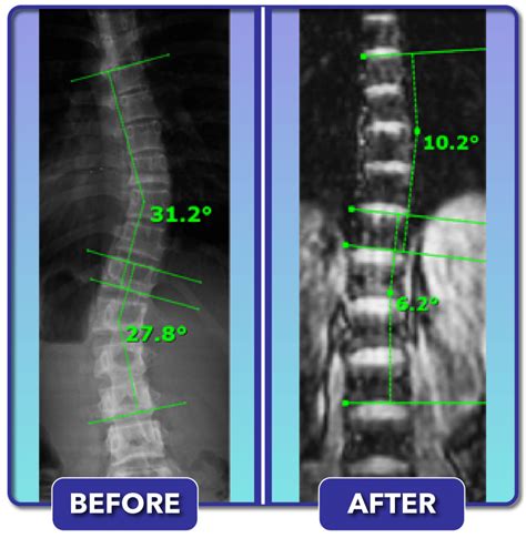 Scoliosis Treatment For Children And Teens Scoliosis Care Centers