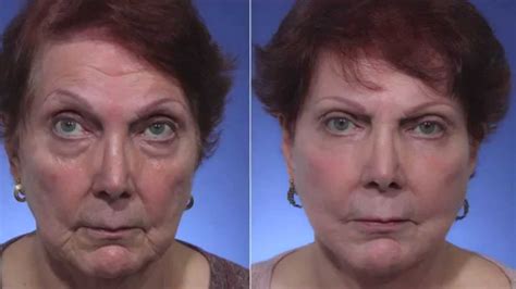Facelift And Facial Rejuvenation In South Florida Youtube