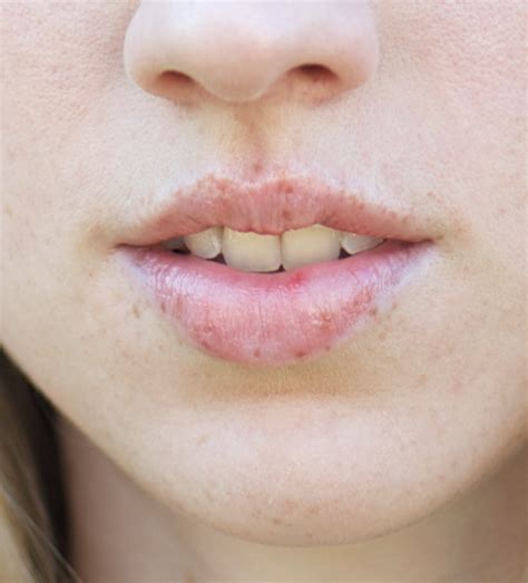 Exploring The Causes Diagnosis And Treatments For Mouth Freckles