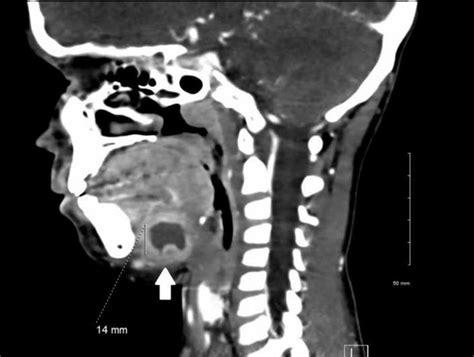 Computed Tomography With A Sagittal View And Intravenous Contrast